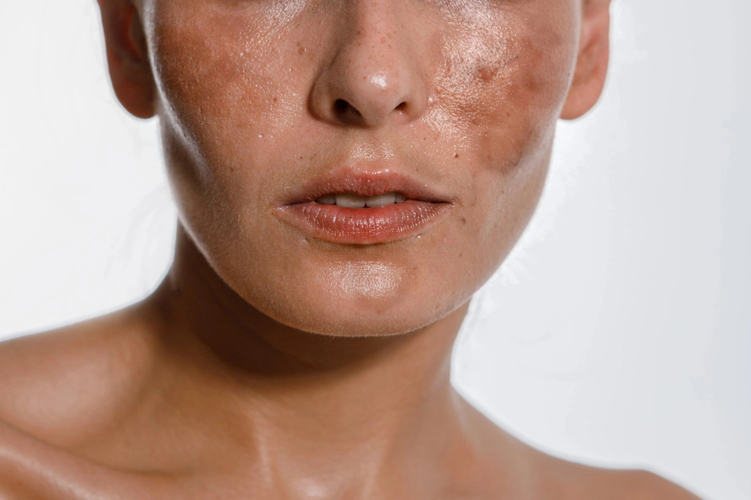 Hyperpigmentation Treatment with Pico Laser In Austin, TX at Glo Med Spa