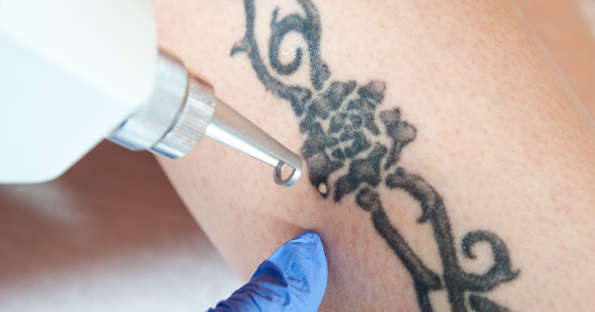 Close-up of laser treatment being performed on a black floral tattoo for Tattoo Removal in Austin, TX, showing precision and professional care.