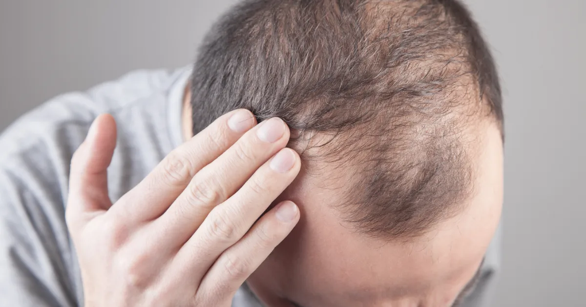 A man showing early signs of hair loss before considering a Hair loss treatment in Austin, TX