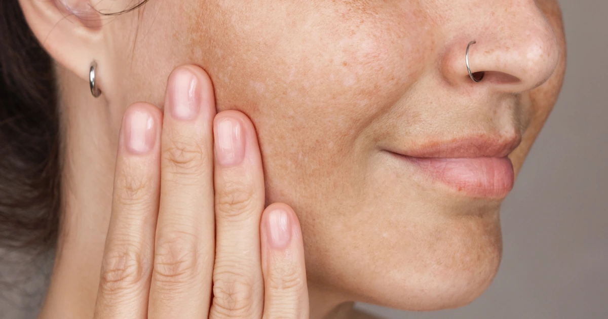 Age Spots Cause and Treatment at Glo Med Spa