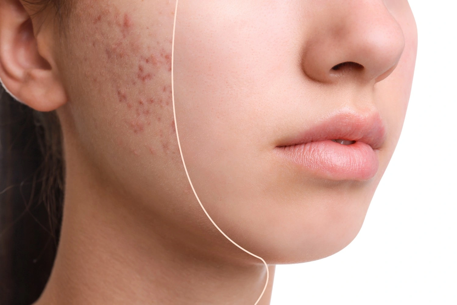 Acne Treatment Specialist In Austin, TX, at Glo Med Spa