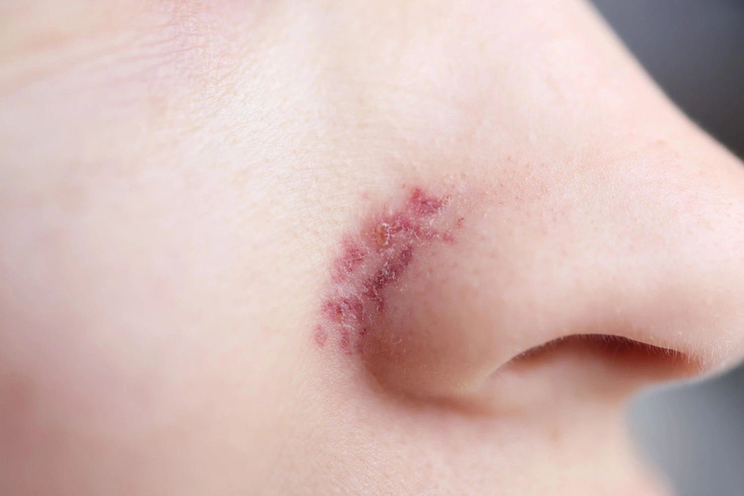 Broken Capillaries Treatment In Austin, TX at Glo Med Spa