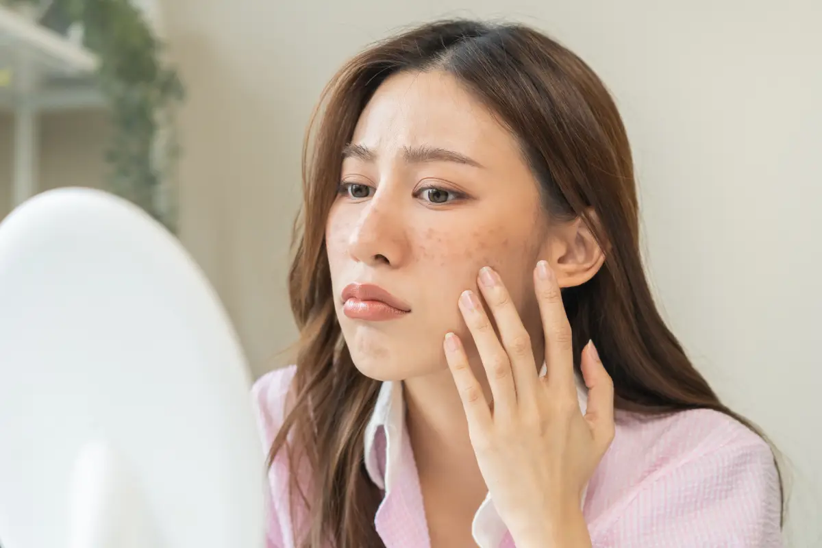 Acne Scar Treatment in Austin, TX at Glo Med Spa