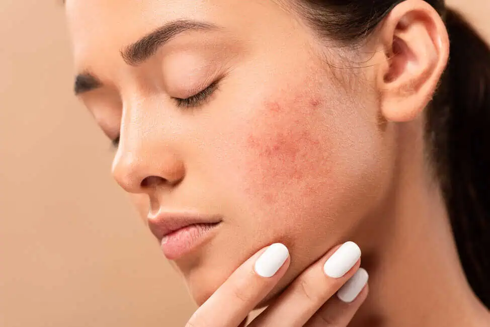 Acne Scar Treatment by Glo Med Spa Austin in Austin, Tx