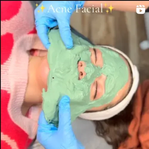 Glo Med Spa Acne Facial Treatment