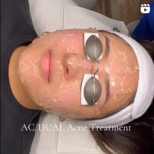 Glo Med Spa AC/DUAL Acne Treatment